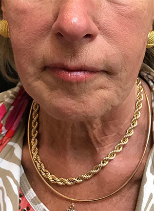 Around The Mouth Fillers