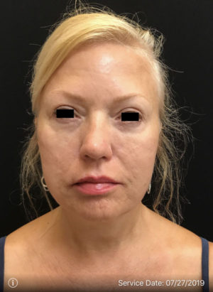 Around The Eye Fillers