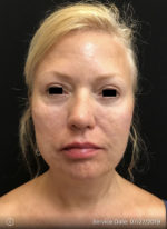 Around The Eye Fillers