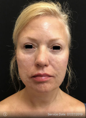 Around The Eye Fillers