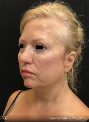 Around The Eye Fillers