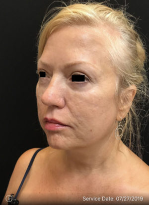 Around The Eye Fillers