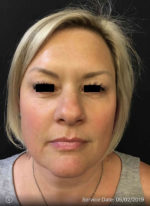 Around The Eye Fillers