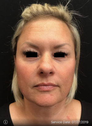 Around The Eye Fillers