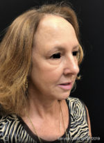 Around The Eye Fillers