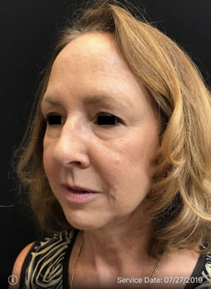 Around The Eye Fillers
