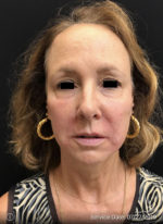 Around The Eye Fillers