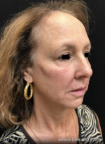 Around The Eye Fillers