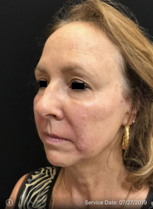 Around The Eye Fillers