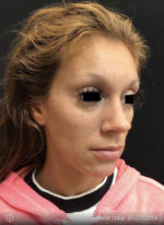 Around The Eye Fillers