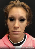 Around The Eye Fillers