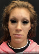 Around The Eye Fillers