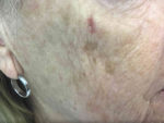 Basal Cell Carcinoma