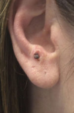 Basal Cell Carcinoma