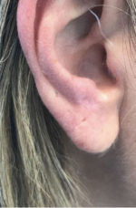 Basal Cell Carcinoma