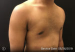 Gynecomastia