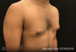 Gynecomastia