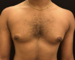 Gynecomastia