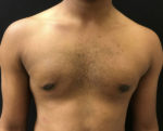 Gynecomastia