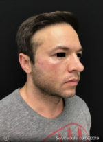 Around The Eye Fillers