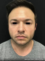 Around The Eye Fillers