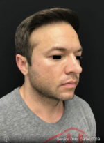 Around The Eye Fillers