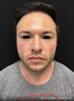 Around The Eye Fillers
