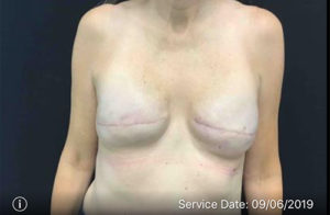 Breast Reconstruction