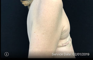 Breast Reconstruction