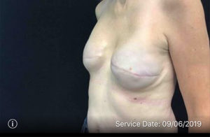 Breast Reconstruction