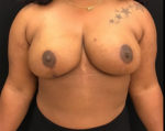 Breast Reduction