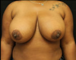 Breast Reduction