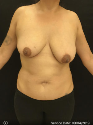 Breast Lift