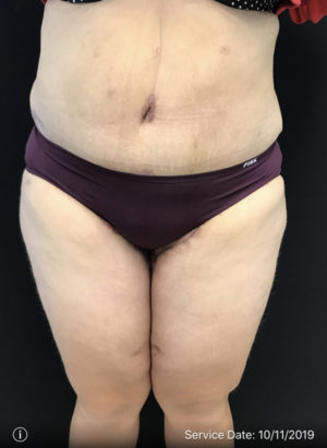 Thigh Lift