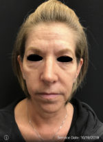 Around The Eye Fillers