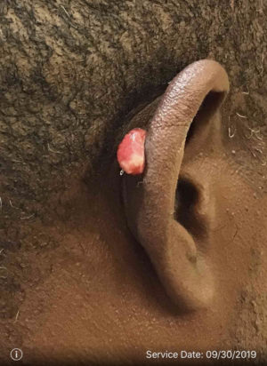 Ear Surgery