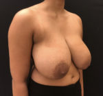 Breast Reduction