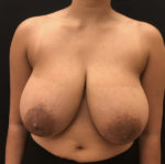 Breast Reduction