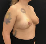 Breast Reduction