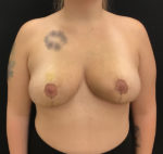 Breast Reduction