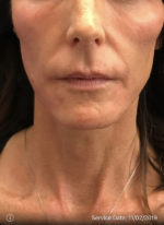 Around The Mouth Fillers