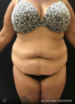 Tummy Tuck