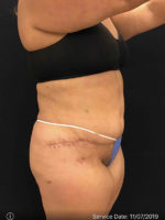 Tummy Tuck