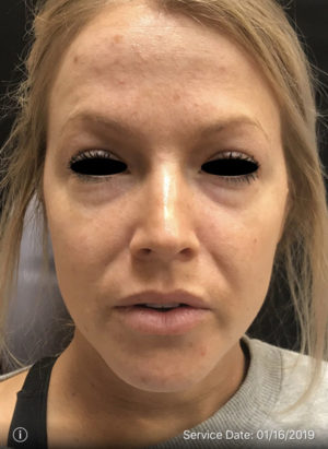 Around The Eye Fillers