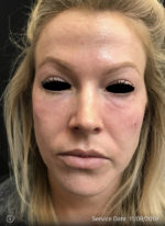 Around The Eye Fillers