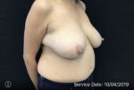 Breast Reduction