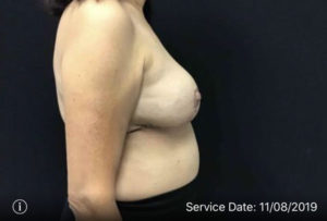 Breast Reduction