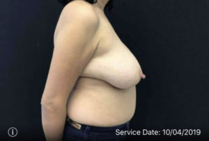 Breast Reduction