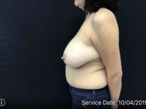 Breast Reduction