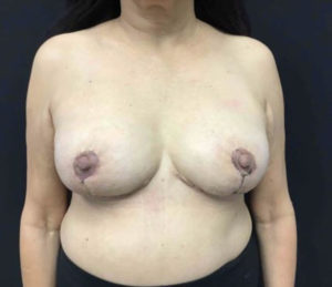 Breast Reduction